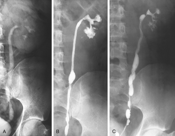 Figure 67-6, A, Excretory urogram in a patient with tuberculosis. Retrograde urograms performed 5 (B) and 7 (C) months later show progressive stenosis and beaded appearance of the ureter.