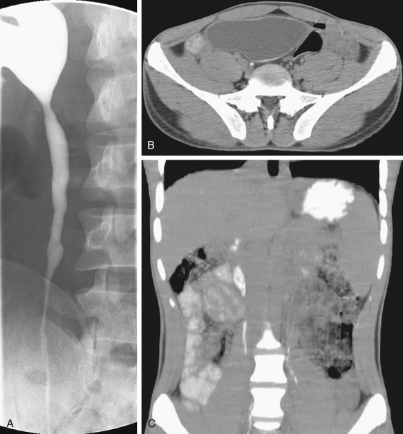 Figure 67-7, A 28-year-old man from Somalia with an 8-year history of intermittent flank pain. A, Anterograde pyelogram shows a long irregular ureteral stricture and hydronephrosis. Noncontrast axial (B) and coronal (C) reconstructed computed tomography images show ureteral and bladder calcifications consistent with the diagnosis of schistosomiasis.