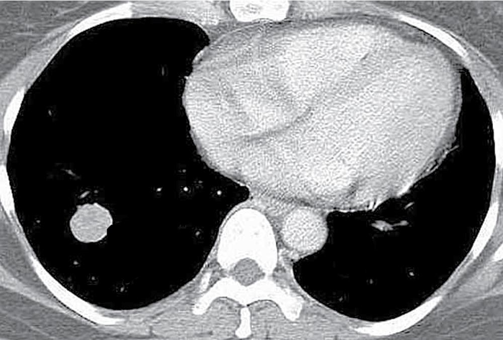 Figure 20.1, This computed tomogram of the lung shows a well-demarcated peripheral nodule with internal calcification, typical of pulmonary hamartoma.