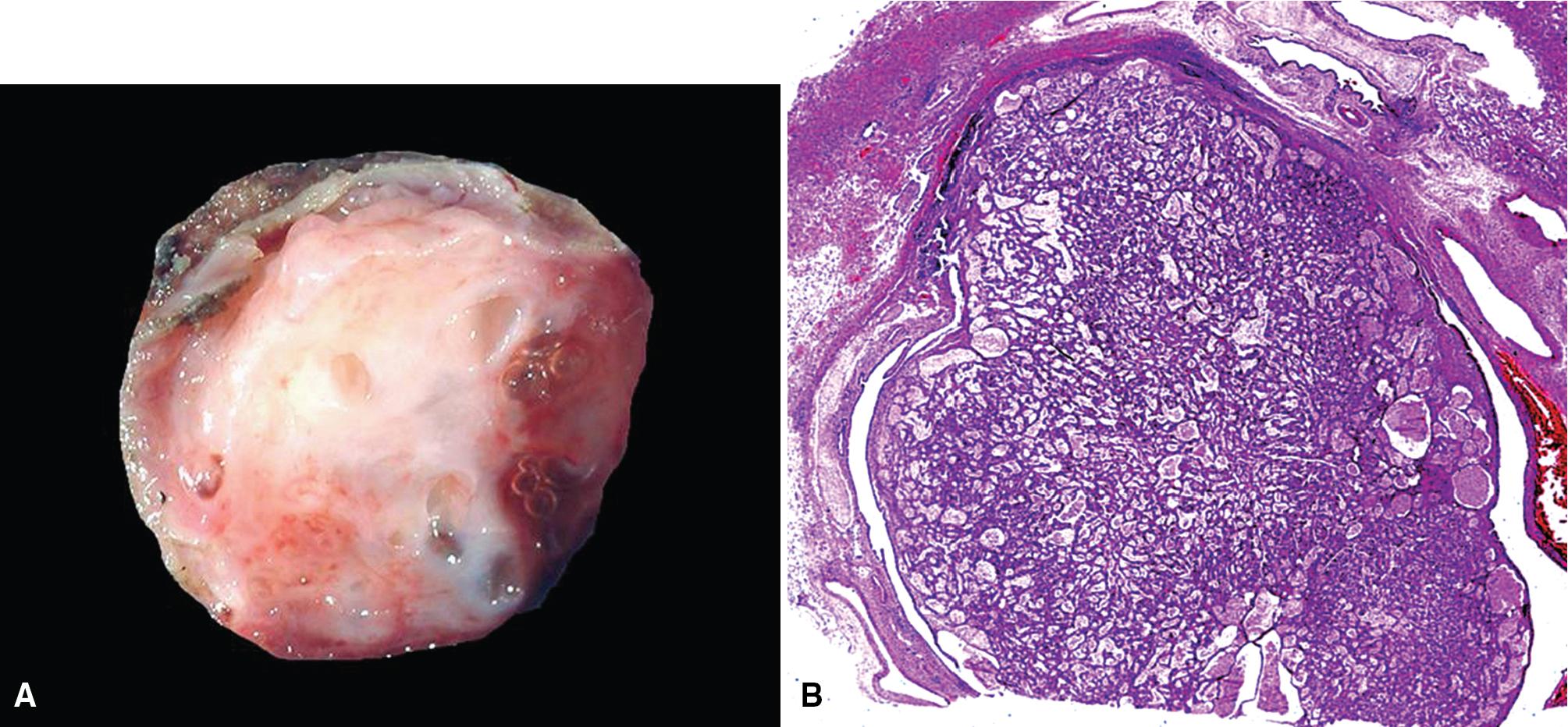 Figure 20.11, Gross (A) and scanning microscopic view (B) of a mucous gland adenoma of the bronchus demonstrating an epithelial lesion that fills the bronchial lumen and shows internal gland formation.