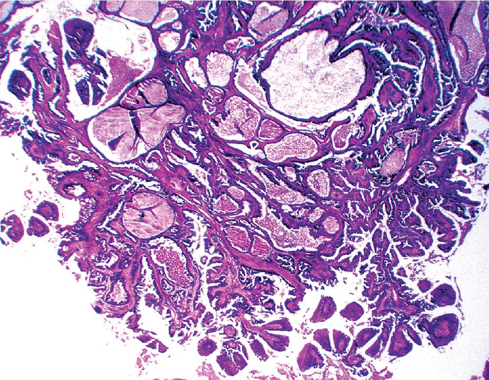 Figure 20.13, This mucous gland bronchial adenoma shows a papillocystic configuration.