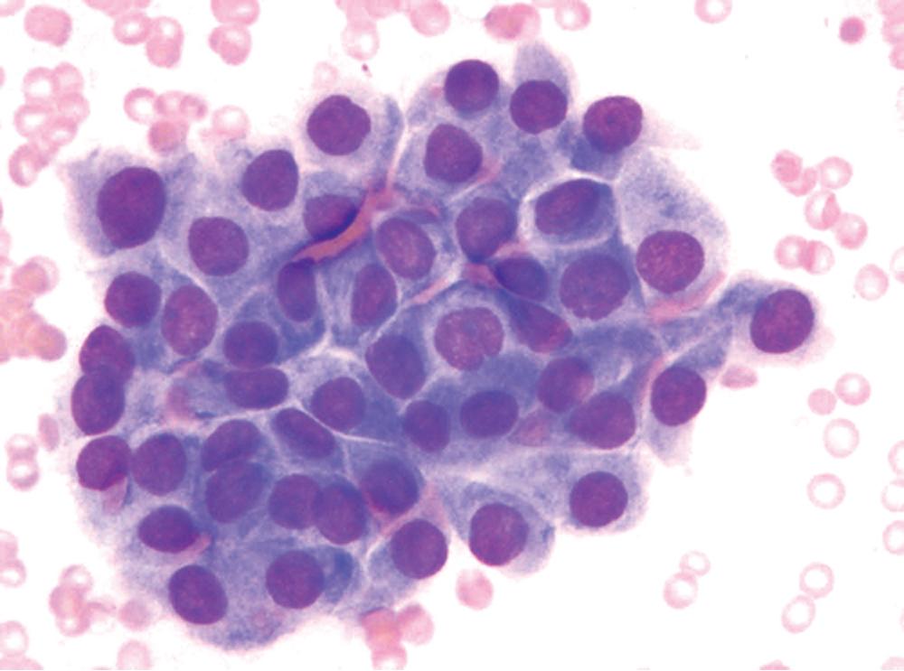 Figure 20.15, Fine-needle aspiration biopsy of mucous gland adenoma showing composition by monomorphic, cohesive polygonal cells with bland nuclear features.