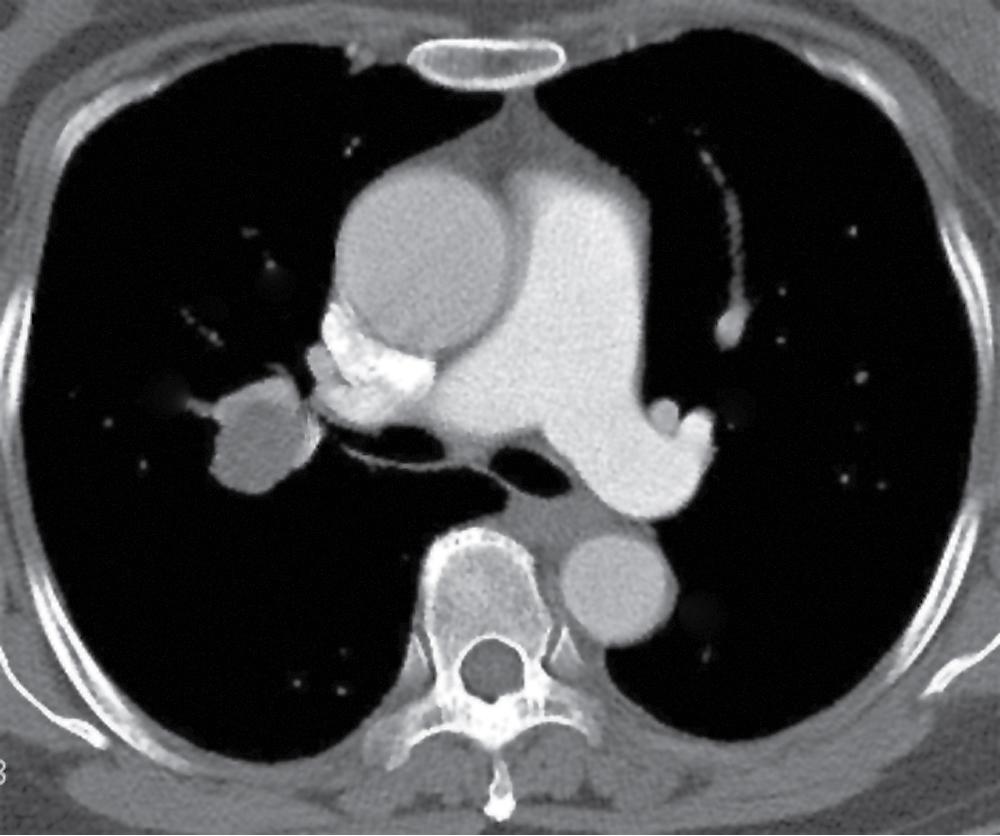 Figure 20.16, This computed tomogram of the chest shows a mass attached to the right bronchus intermedius, representing a mixed tumor.