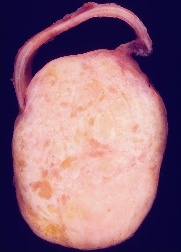 Figure 20.17, Gross photograph of a bronchial mixed tumor showing that the mass is partially intramural with respect to the wall of the airway. The lesion is internally solid, mottled, and white-tan.