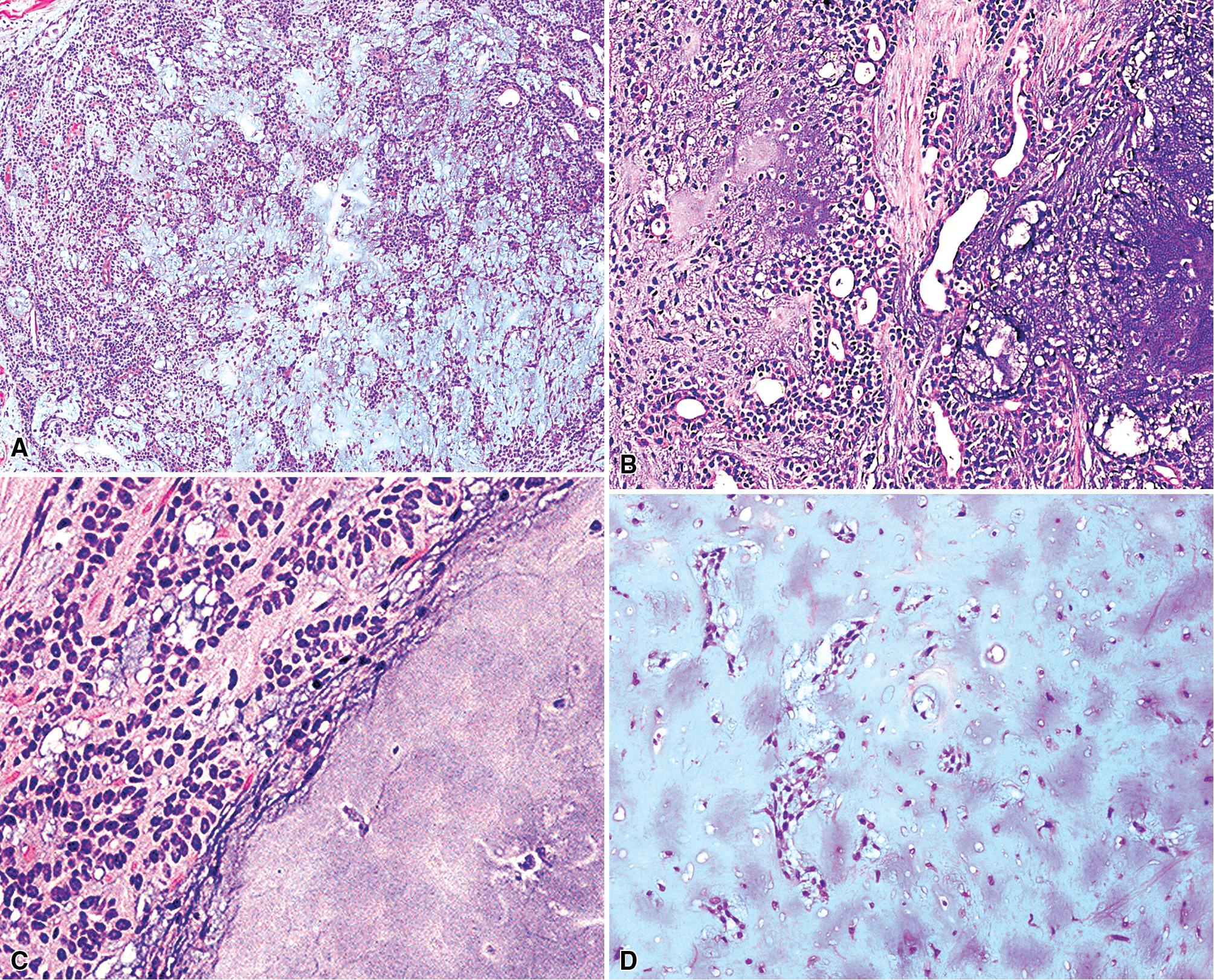 Figure 20.18, (A–C) Bronchial mixed tumors comprise a variable mixture of solid epithelial, tubular, and chondroid matrical elements. (D) This mixed tumor is almost completely composed of chondroid stroma, simulating a chondroma.