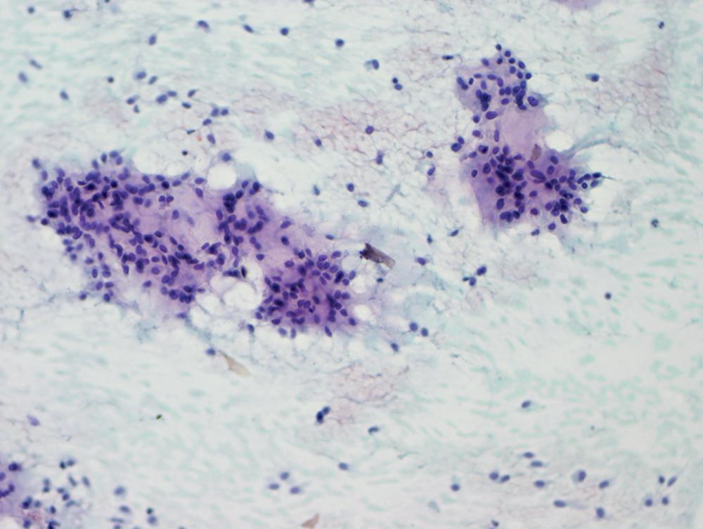 Figure 20.19, Fine-needle aspiration of a mixed tumor showing classic fibrillary stromal material admixed with bland-appearing basaloid epithelial cells.