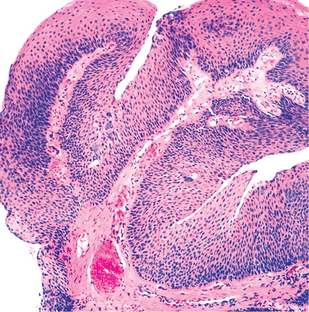 Figure 20.2, Solitary papilloma of the bronchus represented by a papillary proliferation of bland squamous epithelium supported by well-formed fibrovascular stroma.