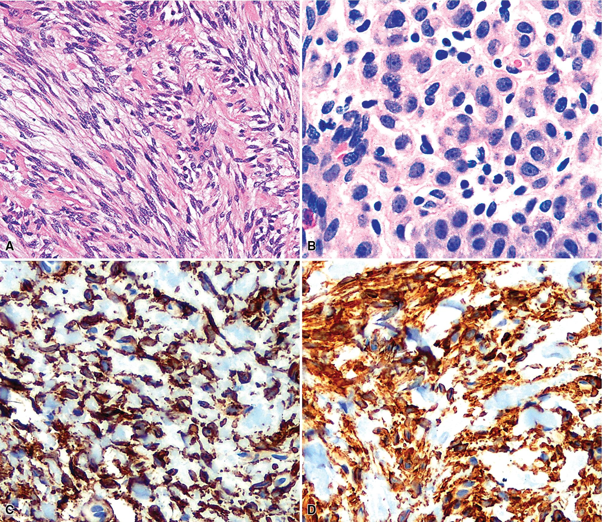 Figure 20.21, Myoepitheliomatous variants of mixed tumor showing spindle cell (A) and plasmacytoid cell (B) compositions. These lesions are immunoreactive for both keratin (C) and muscle-specific actin (D).