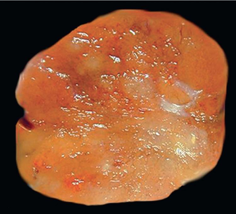 Figure 20.23, Bronchial oncocytoma has a relatively uniform, fleshy, brown cut surface.