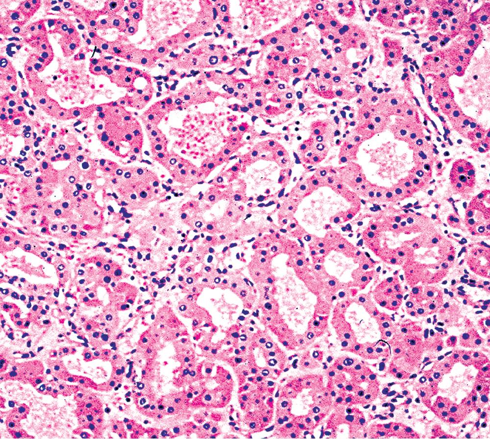 Figure 20.24, Either solid or tubular profiles of oxyphilic polygonal cells can be seen in oncocytoma.