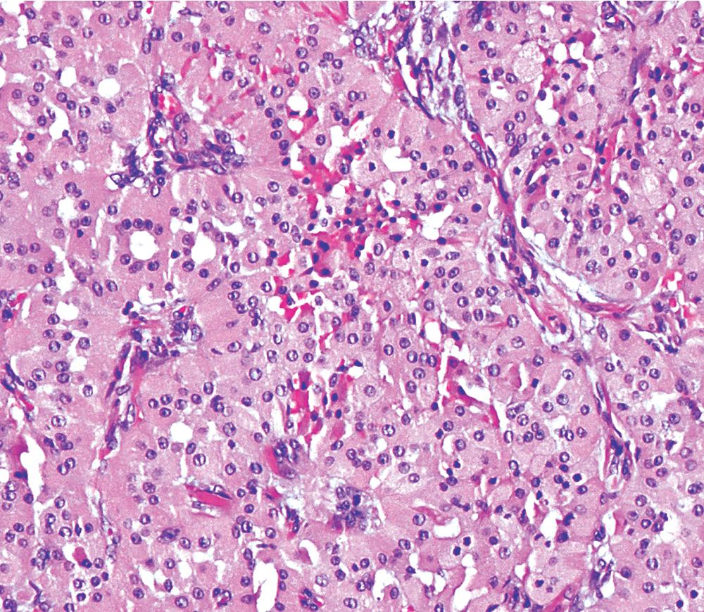 Figure 20.25, Tumor cells in oncocytoma have oval nuclei with dispersed chromatin, distinct chromocenters, and abundant granular eosinophilic cytoplasm.