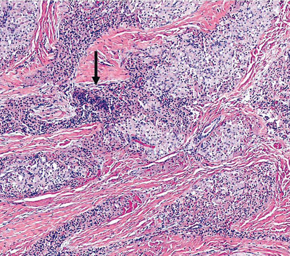 Figure 20.26, A rare example of bronchial oncocytoma shows infiltrative growth and focal necrosis (arrow) , justifying an interpretation of malignancy.
