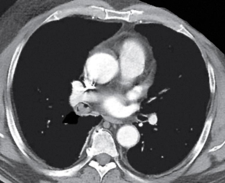 Figure 20.27, A computed tomographic image of a bronchial neurilemmoma showing a mass in the lumen of the right mainstem bronchus.