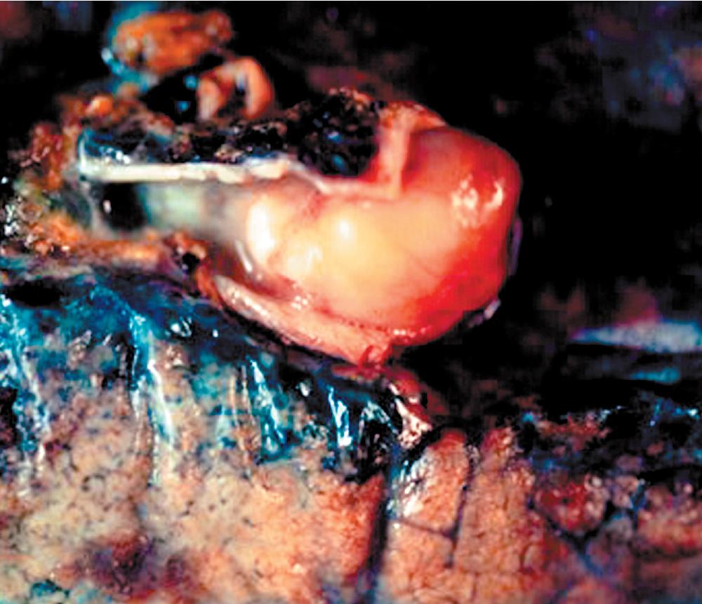 Figure 20.29, The resected lung in a case of bronchial neurilemmoma demonstrates occlusion of the bronchial lumen by a uniform, yellow, solid tumor.