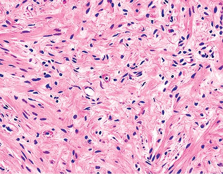 Figure 20.30, The tumor cells in neurofibroma show serpiginous nuclear profiles and eosinophilic cytoplasm. They are bland, with no nuclear atypia or mitotic activity.