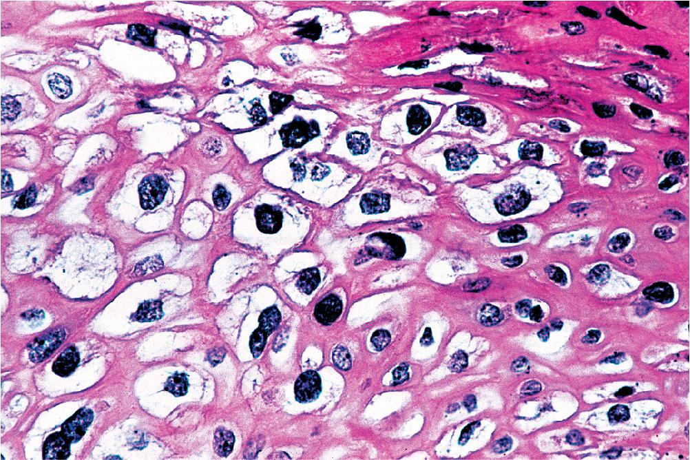 Figure 20.3, Koilocytotic change in the squamous cells of a solitary bronchial papilloma represented by nuclear hyperchromasia and crenation and perinuclear clearing of the cytoplasm.