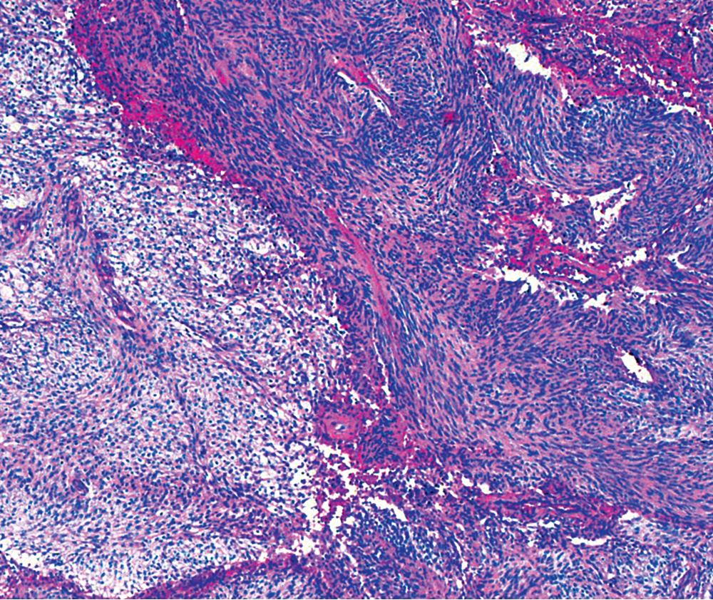 Figure 20.32, An Antoni B focus in a bronchial neurilemmoma (lower left) with a myxoid intercellular matrix.