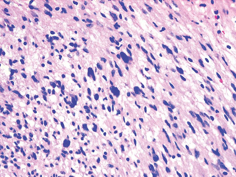 Figure 20.35, “Ancient” neurilemmoma showing degenerative atypia of tumor cell nuclei with mild pleomorphism and hyperchromasia.