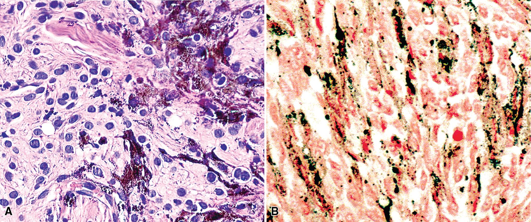 Figure 20.36, (A) Melanotic psammomatous schwannoma (neurilemmoma) exhibiting internal microcalcifications and cytoplasmic pigment. (B) Positivity with a Fontana-Masson stain confirms the identity of the intralesional pigment as melanin.