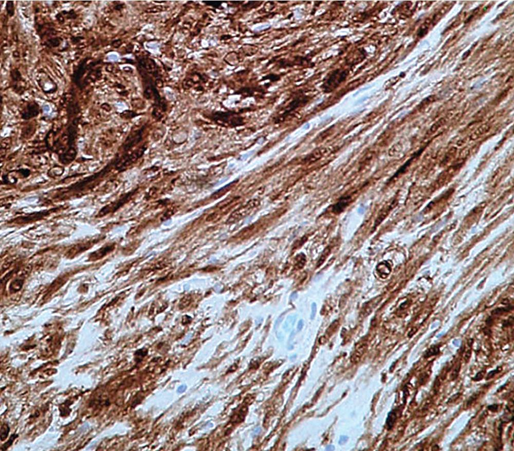 Figure 20.37, Intense immunoreactivity for S-100 protein is seen in this bronchial neurilemmoma.