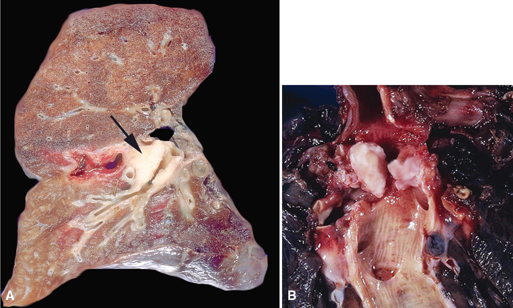 Figure 20.38, (A and B) The homogeneous white-gray cut surface of an endobronchial granular cell tumor (arrow) is seen in these gross photographs.