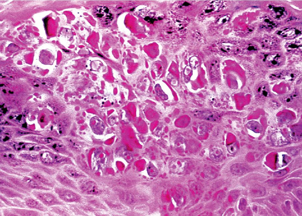 Figure 20.4, Clumped keratohyaline and eosinophilic cytoplasmic inclusions are seen in the lesional cells of this solitary squamous papilloma of the bronchus with a viral causation.