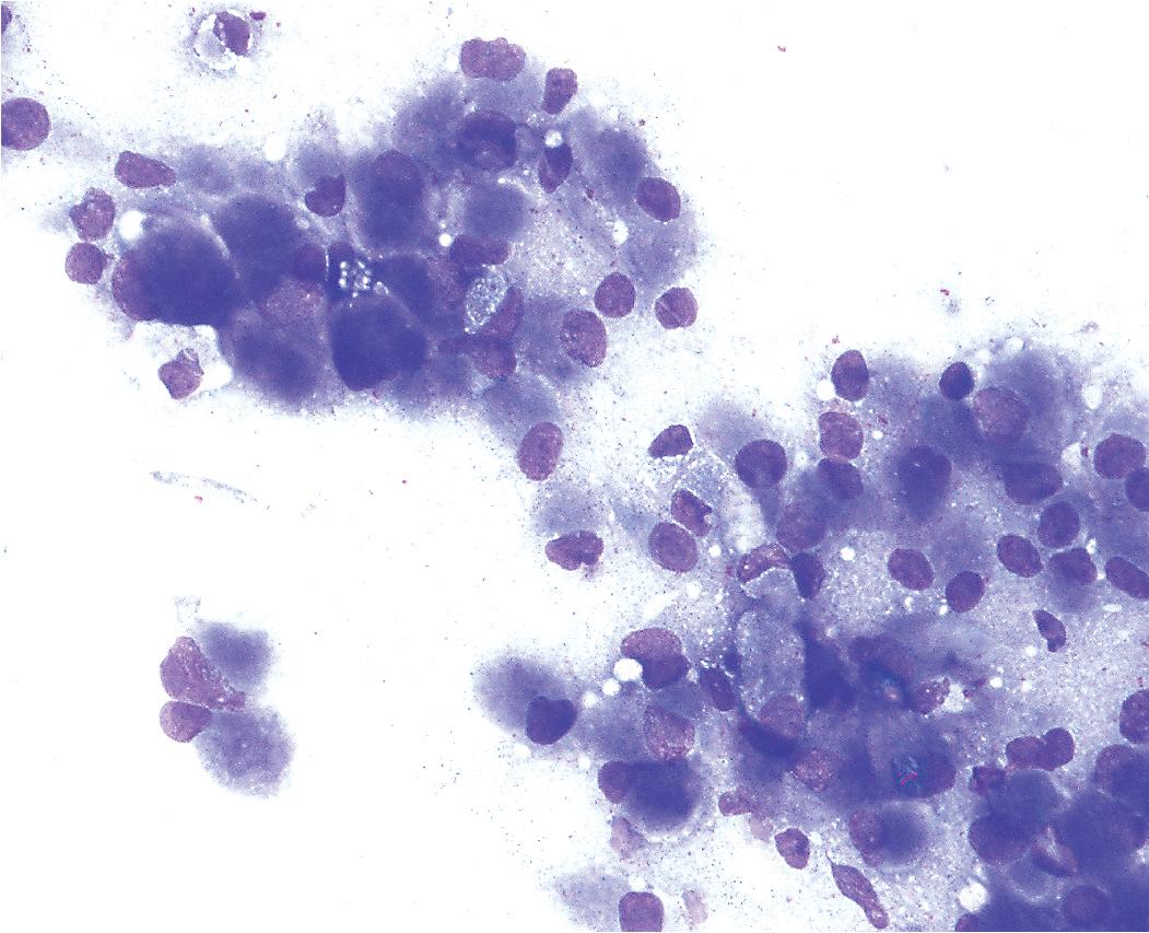 Figure 20.41, A fine-needle aspiration biopsy specimen of a bronchial granular cell tumor recapitulates and amplifies the cytologic features seen in tissue sections.