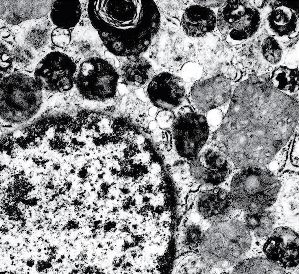 Figure 20.42, This electron photomicrograph of a granular cell tumor demonstrates innumerable secondary and tertiary cytoplasmic lysosomes.