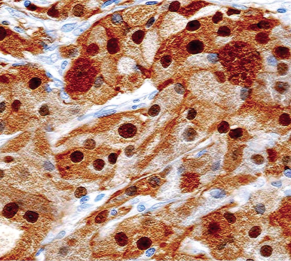 Figure 20.43, Nuclear and cytoplasmic immunoreactivity for S-100 protein in a bronchial granular cell tumor. This marker is present in approximately 80% of such lesions.