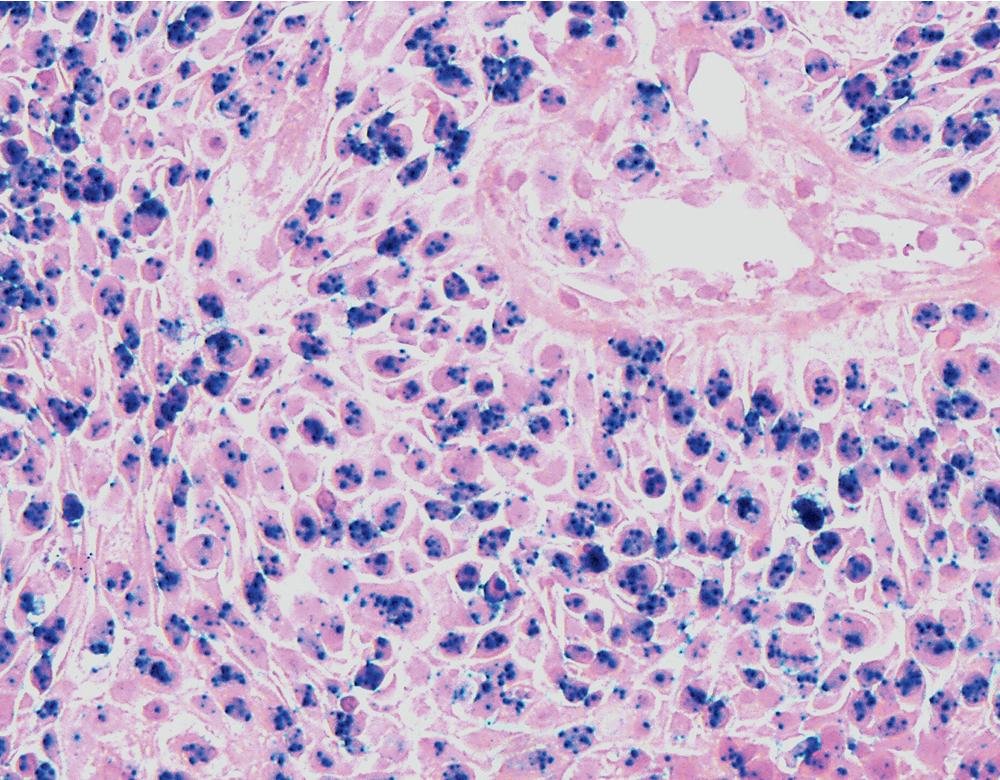 Figure 20.5, The presence of integrated nucleic acid from human papillomavirus type 11 is apparent in this in situ hybridization preparation, as evidenced by nuclei that show a blue chromogenic signal.