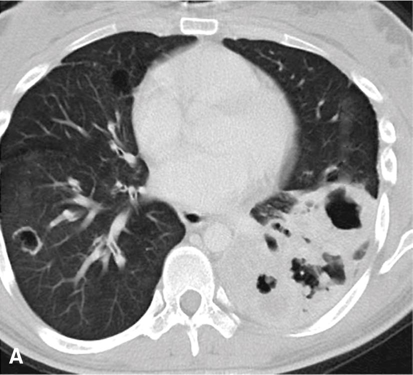 Figure 20.6, Rarely, multifocal respiratory papillomatosis may give rise to squamous cell carcinoma manifested as a mass in the posterior left lung, seen on this computed tomogram (A) and microscopically (B and C).