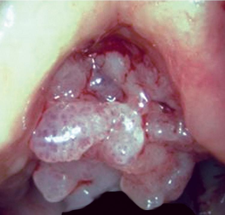 Figure 20.7, Bronchoscopic appearance of multifocal respiratory papillomatosis showing a multiplicity of smooth-domed and confluent lesions in the bronchial mucosa.