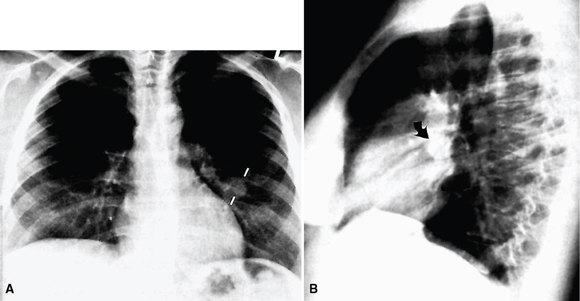 Figure 20.10, Posteroanterior (A) and lateral (B) chest radiographs showing a nodular lesion that is centered on a bronchus (arrow) that proved to be a mucous gland adenoma.