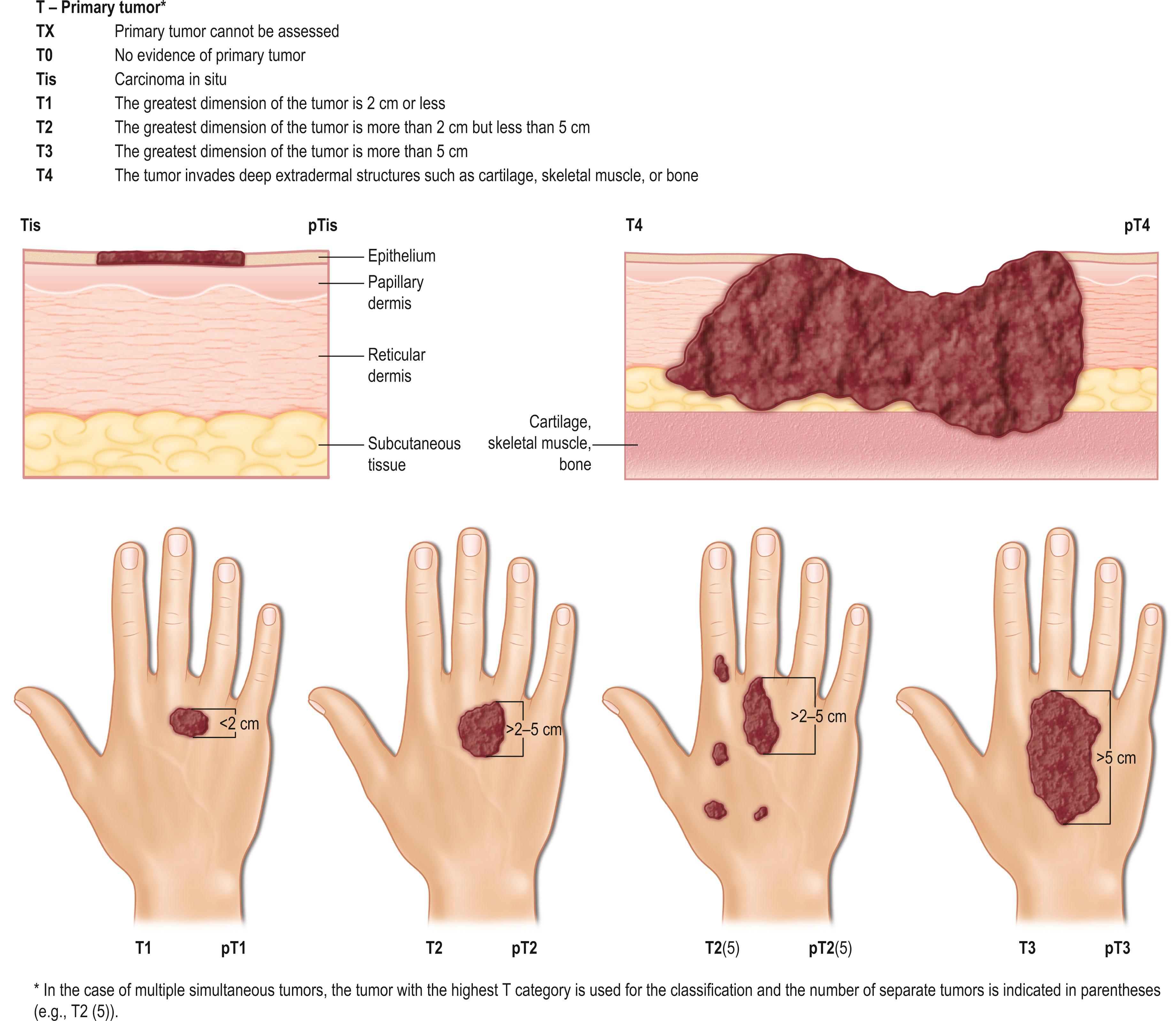 Figure 29.3, The T factor of the TNM classification system, as described by the Union for International Cancer Control (UICC).