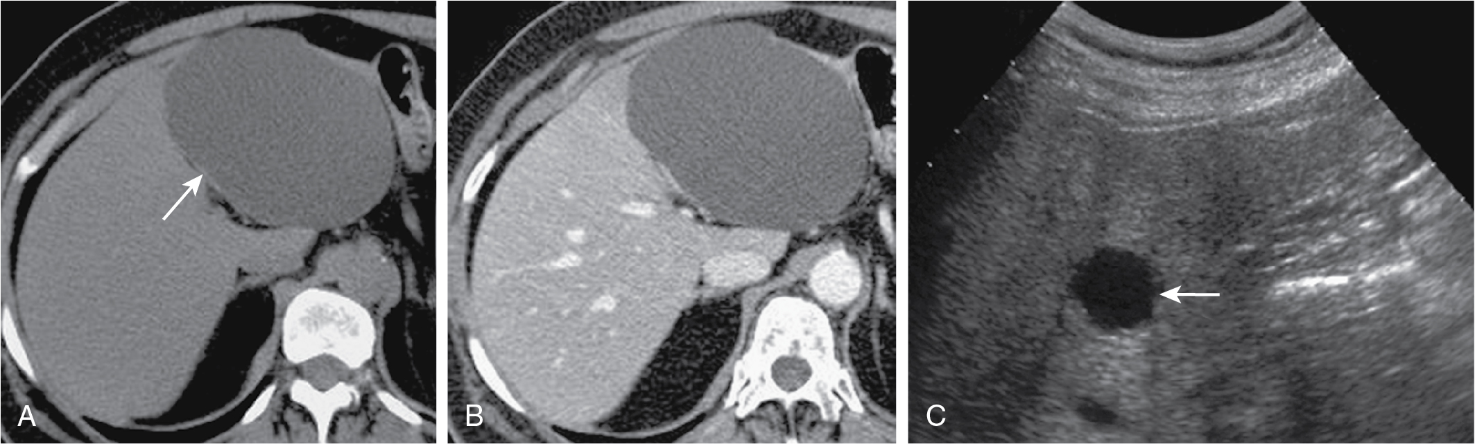 Fig. 17.3, Typical presentation of hepatic (bile duct) simple cyst. A, Axial precontrast computed tomography (CT) image shows a large, sharply defined lesion ( arrow ) in the left lobe of the liver that is hypoattenuating compared with the surrounding hepatic parenchyma and aorta. Hypoattenuation to the aorta on precontrast images is the single most important finding to diagnose cystic lesions on CT. B, Corresponding contrast-enhanced CT scan during portal venous phase demonstrates absence of lesion enhancement. C, Ultrasound image in a different patient shows a round, well-circumscribed mass ( arrow ) with imperceptible wall and increased through-transmission of sound waves.