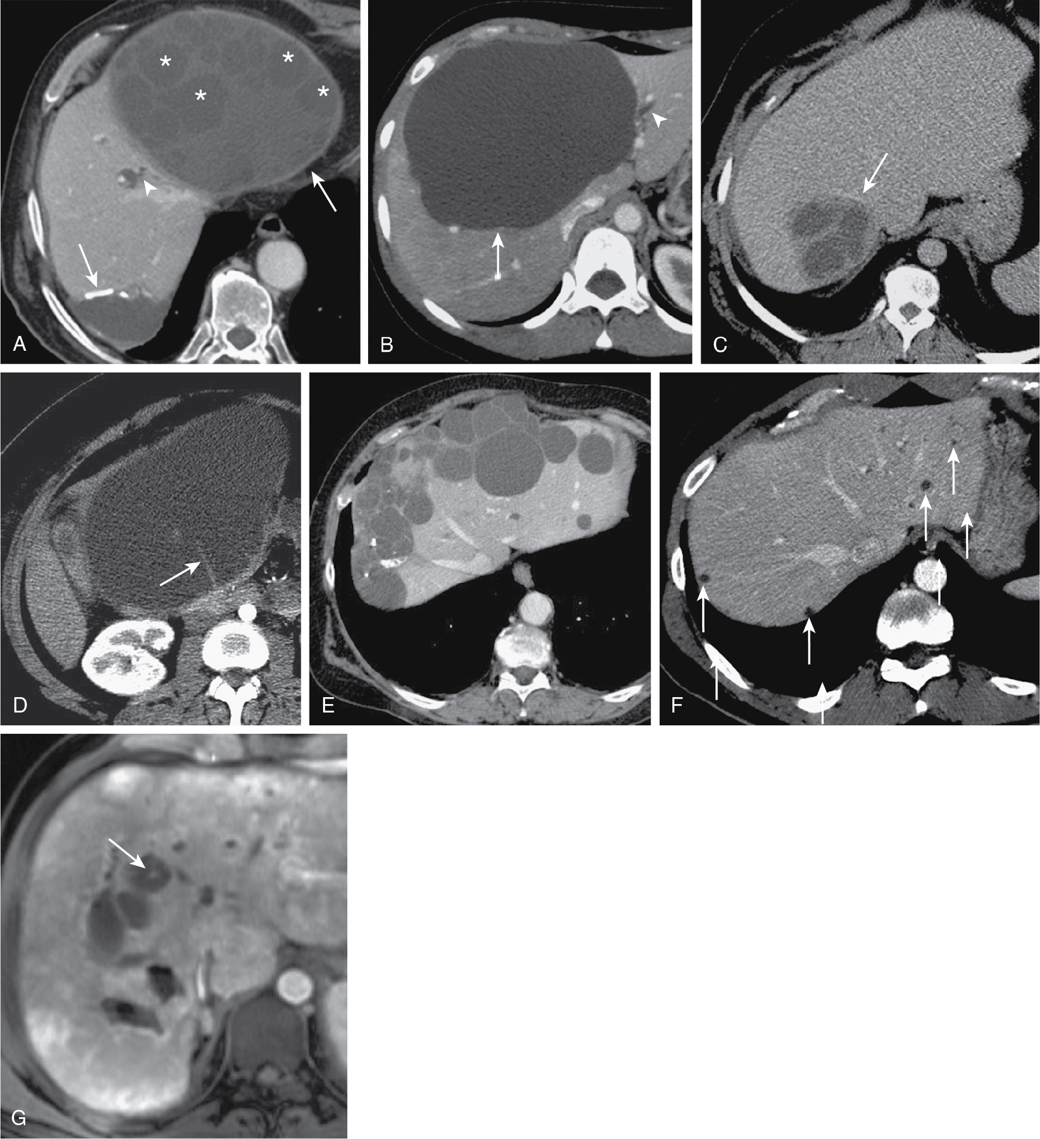 Fig. 17.4, Imaging findings and differential diagnosis among different cystic lesions of the liver, including hydatid cyst, simple cyst, pyogenic abscess, biliary cystadenoma, polycystic liver disease, biliary hamartomas, and Caroli disease. A to F, Portal venous phase computed tomography. G, Gadolinium-enhanced T1-weighted gradient recalled echo magnetic resonance image. A, Calcified wall ( black arrow ), thick enhancing wall ( arrow ), and daughter cysts ( asterisks ) are typical of hydatid cyst. B, A simple hepatic cyst has no visible wall ( arrow ). Note the mild intrahepatic biliary dilatation ( arrowhead ) secondary to mass effect in both cases. Other findings that may help in narrowing differential diagnosis when facing cystic liver lesions are (C and D) thick enhancing walls ( arrow, C) and internal septa ( arrow, D) in pyogenic liver abscess and biliary cystadenoma, (E) multiplicity and partially calcified walls in polycystic liver disease, (F) small size (<15 mm) and multiplicity ( arrows ) in biliary hamartomas, and (G) demonstration of a “dot sign” ( arrow ) resulting from a centrolesional portal venous branch in Caroli disease.