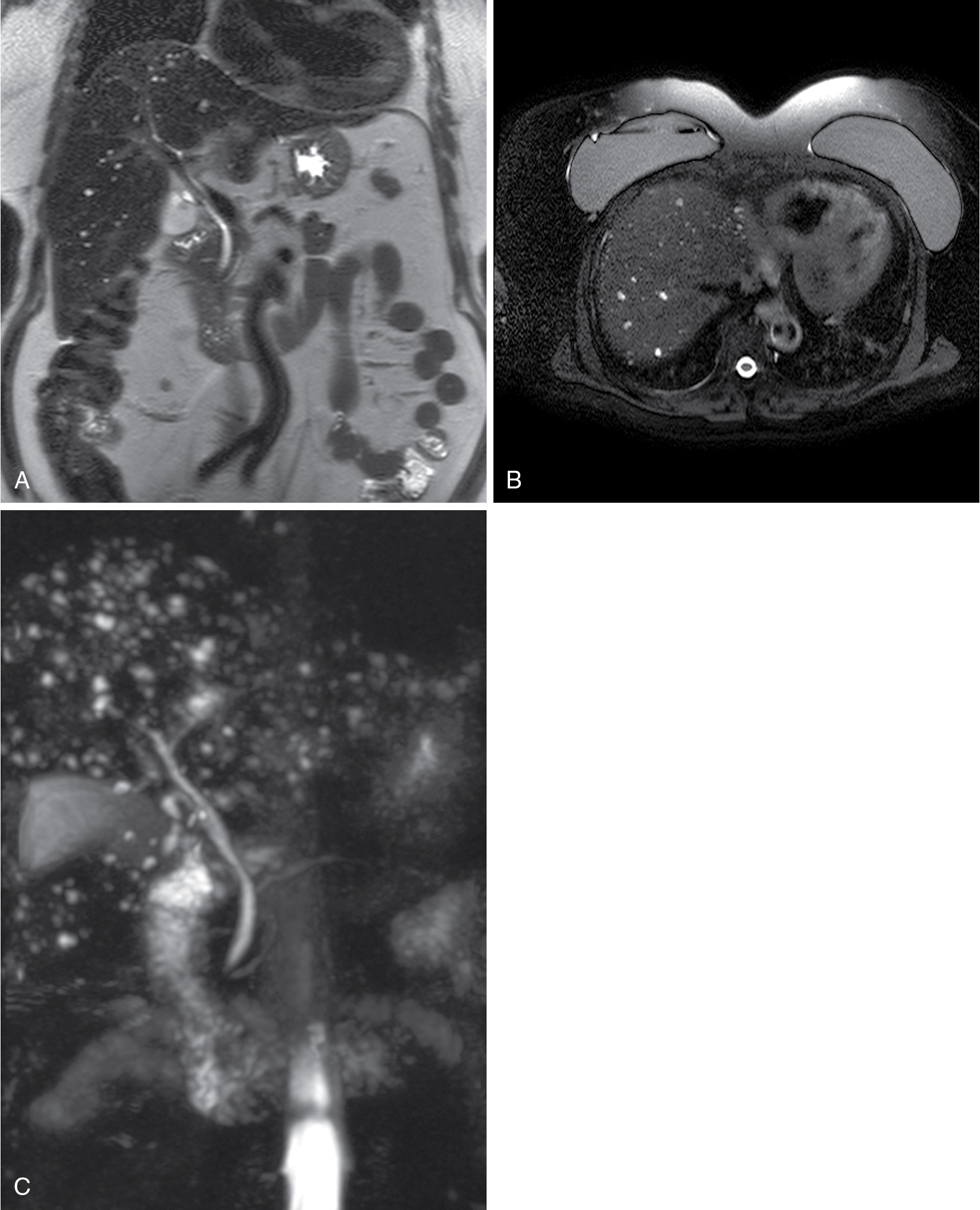 Fig. 17.5, Biliary hamartoma. The coronal heavily T2-weighted (A) and fat-suppressed, moderately T2-weighted (B) images reveal multiple small fluid-intense lesions scattered throughout the liver. The maximal intensity projection image from a three-dimensional magnetic resonance cholangiopancreatography sequence (C) confirms high fluid content isointense to bile. Note the mild hyperintensity of the breast implants, typical of silicone and less intense than saline.