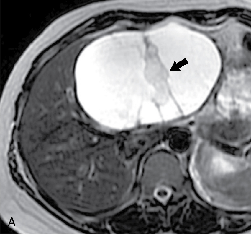 Fig. 17.7, Axial T2-weighted (A) and postcontrast (B) magnetic resonance imaging in a 36-year-old woman with a complex cystic 9-cm biliary cystadenoma. Note internal septa ( arrows ).