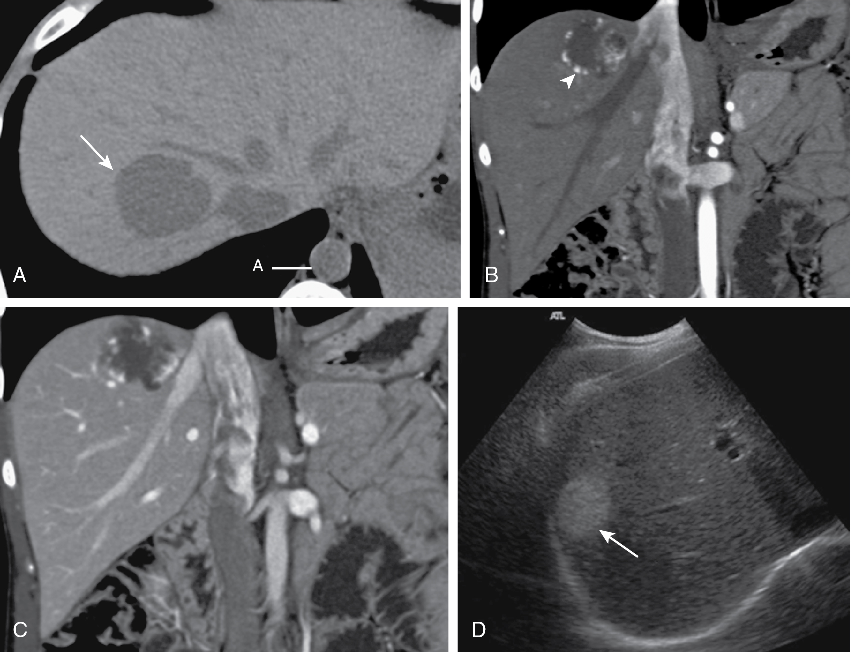 Fig. 17.9, Typical cavernous hemangioma. A, Axial precontrast computed tomographic image shows a 4-cm, hypoattenuating lesion ( arrow ) in the right lobe of the liver. Note the equal attenuation of the lesion with both aorta ( A ) and intrahepatic vessels. B and C, Coronally reformatted images of the same patient demonstrate nodular, peripheral, discontinuous enhancement ( arrowhead, B) on both (B) hepatic arterial phase and (C) portal venous phase, which is comparable to vessels on all vascular phases. D, Ultrasound image in a different patient shows a homogeneous, well-defined, hyperechoic lesion ( arrow ) of the right hepatic lobe.