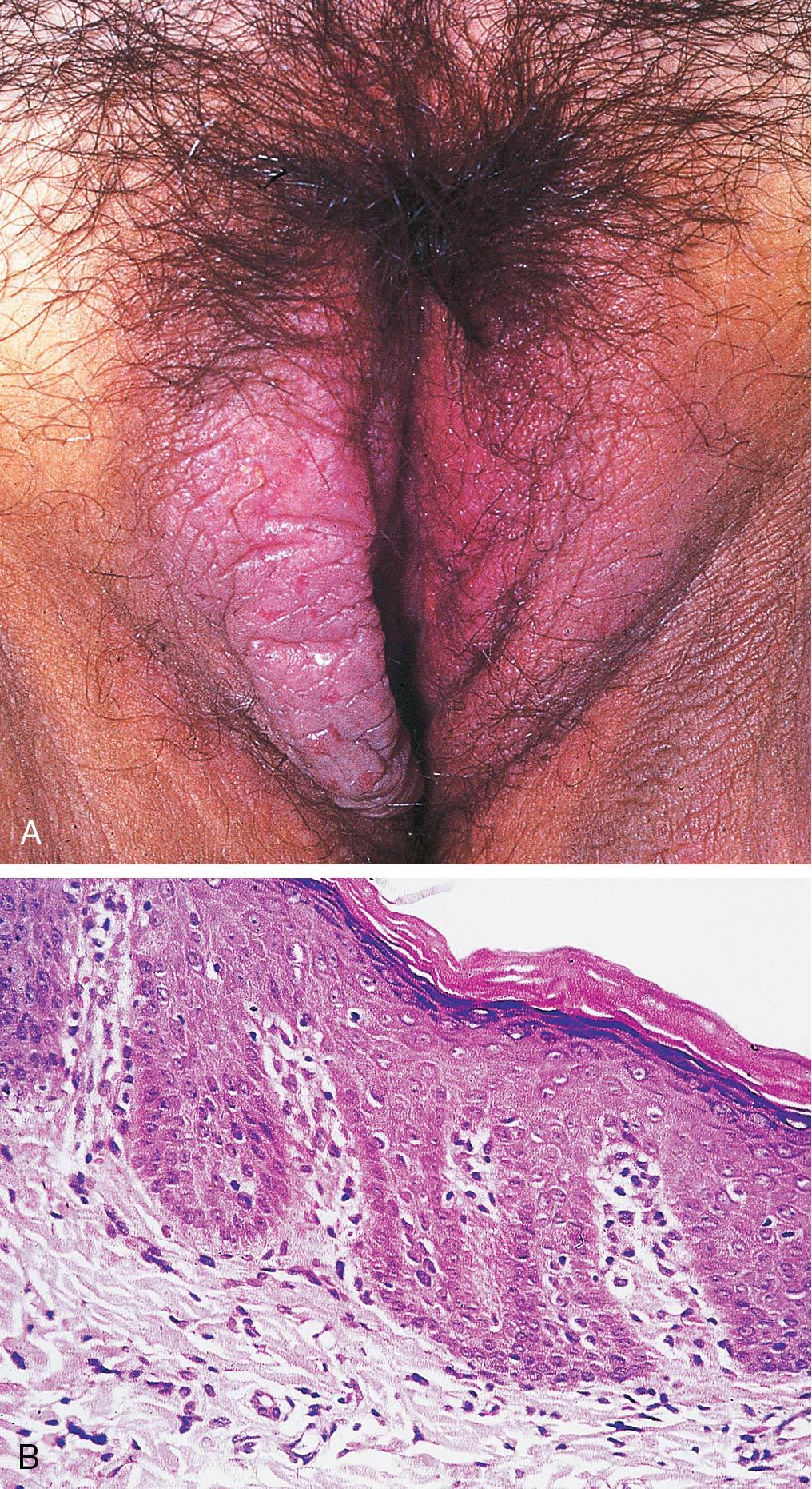 Fig. 18.12, A, Lichen simplex chronicus manifesting of the right labium majus. There is thickening and accentuation of skin markings, with surface excoriation caused by recent scratching. B, Lichen simplex chronicus. The epidermis shows thickening of rete ridges, thickening of the granular layer, and overlying hyperkeratosis.