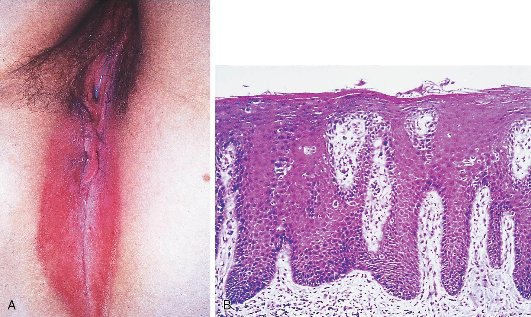 Fig. 18.13, A, Psoriasis of perineum and vulva. Flexural psoriasis often lacks the typical parakeratotic scale of psoriasis on other body sites. Painful erosion of the natal cleft is common. B, Psoriasis. There is psoriasiform hyperplasia of rete ridges with papillary dermal edema and telangiectasia. The parakeratotic scale on the skin surface is not prominent in vulvar psoriasis.