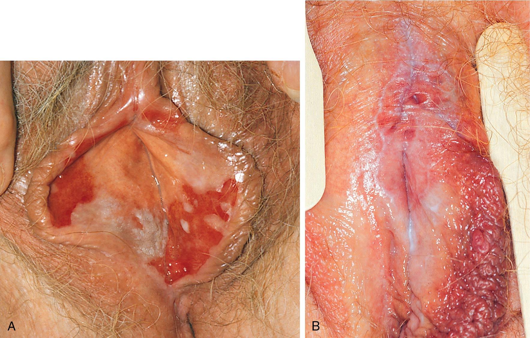 Fig. 18.14, Lichen planus. A, Eroded ulcers in the vulva. B, Lacy reticulated pattern of lichen planus with periclitoral scarring in a 71-year-old woman who has had oral lichen planus for 10 to 15 years, cutaneous lichen planus of arms and legs for 18 months, and bouts of erosive vaginal lichen planus with scarring and partial vaginal stenosis.