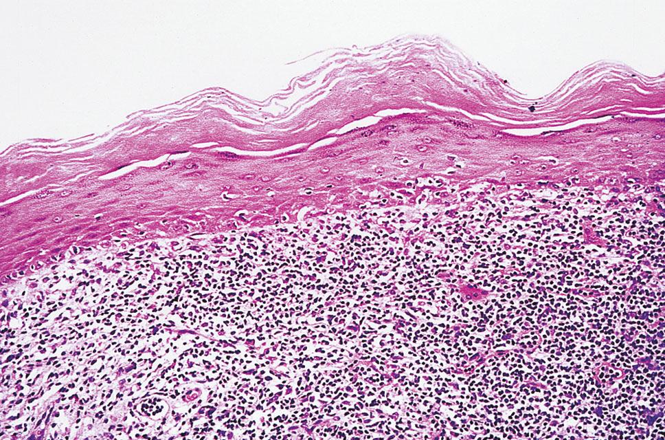 Fig. 18.15, Lichen planus, histologic view. Note hyperkeratosis with extensive basal layer destruction and a dense lichenoid infiltrate at the dermoepidermal junction.