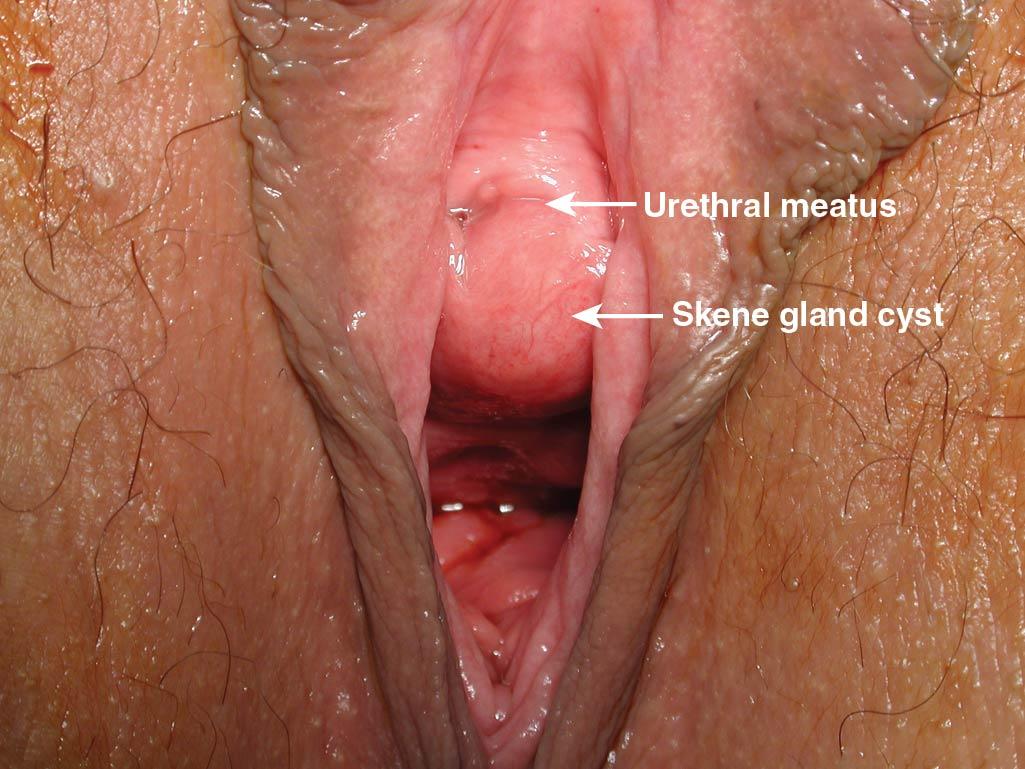 Fig. 18.3, Skene gland cyst.