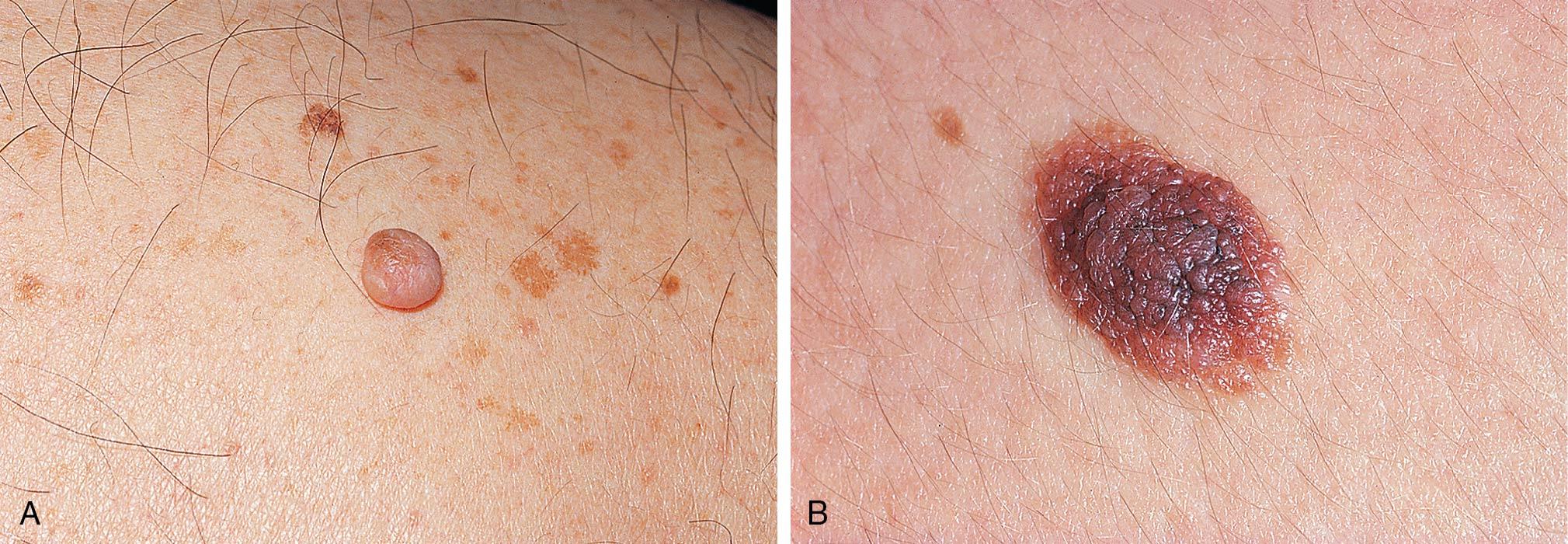 Fig. 18.4, Vulvar nevi. A, Dome-shaped intradermal nevus. B, Compound nevus with irregular pigmentation.