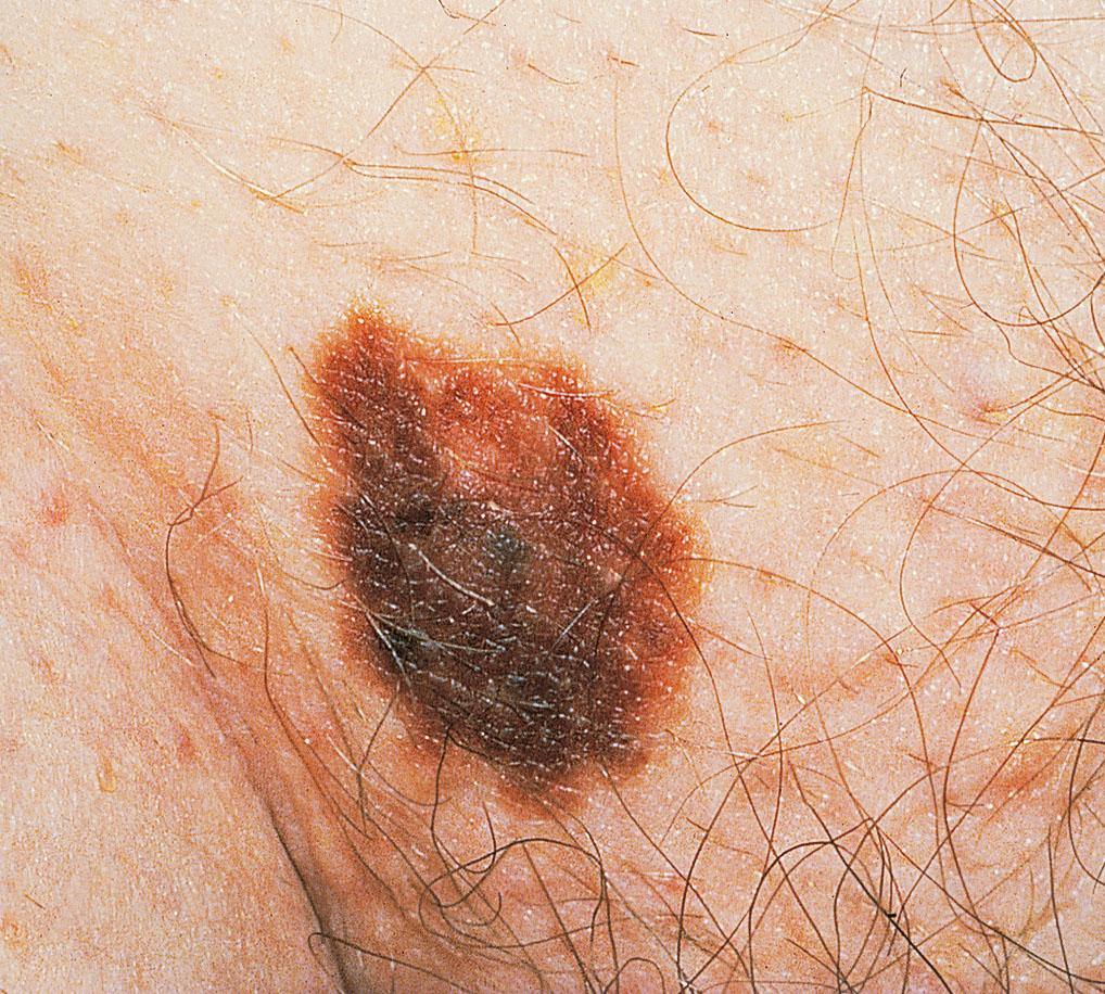 Fig. 18.5, Suprapubic dysplastic nevus with an irregular shape, reddish hue to the edges, and indistinct margins.