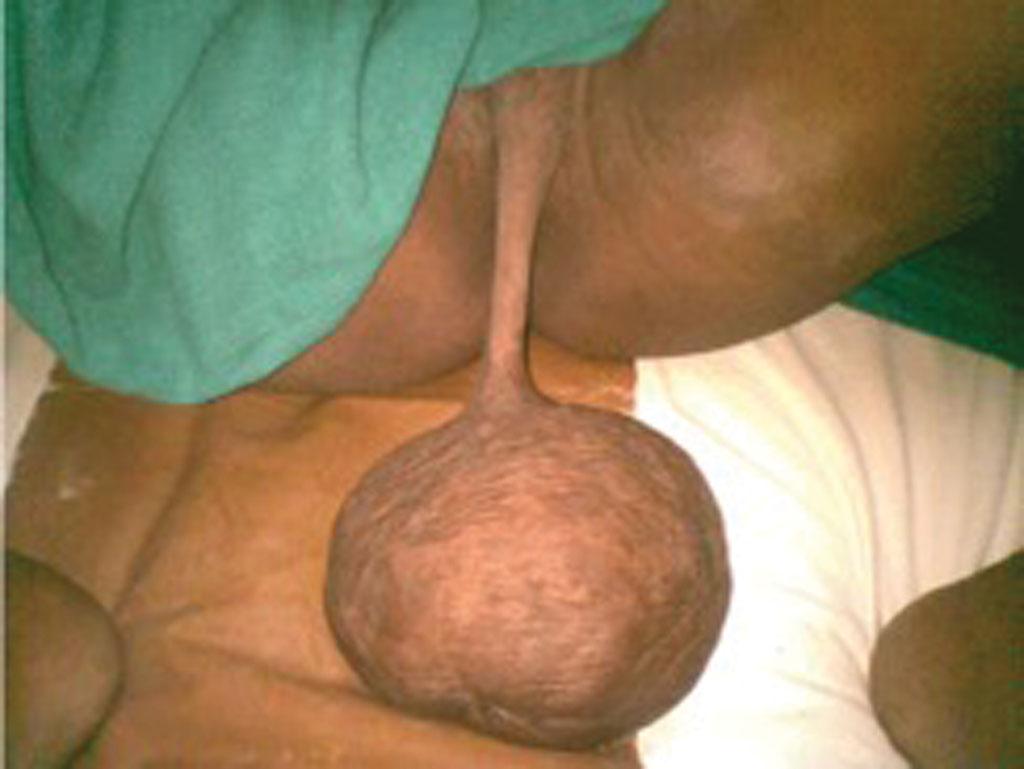 Fig. 18.6, Clinical photograph of a patient showing a pedunculated fibroma from the labia majora.