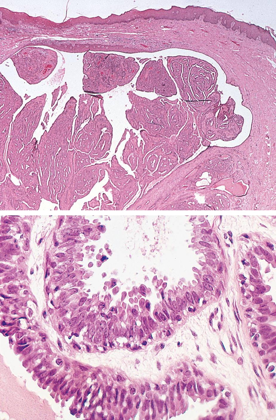 Fig. 18.9, Histologic views: low- and high-power micrographs of hidradenoma.