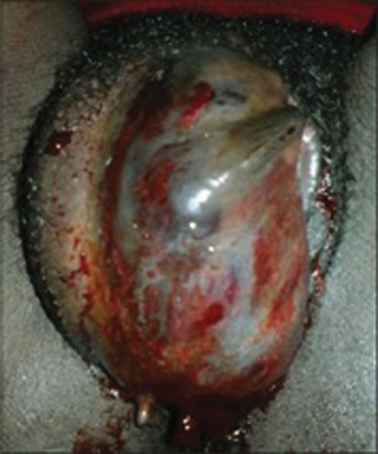 Fig. 18.10, Traumatic hematoma of the left vulva.