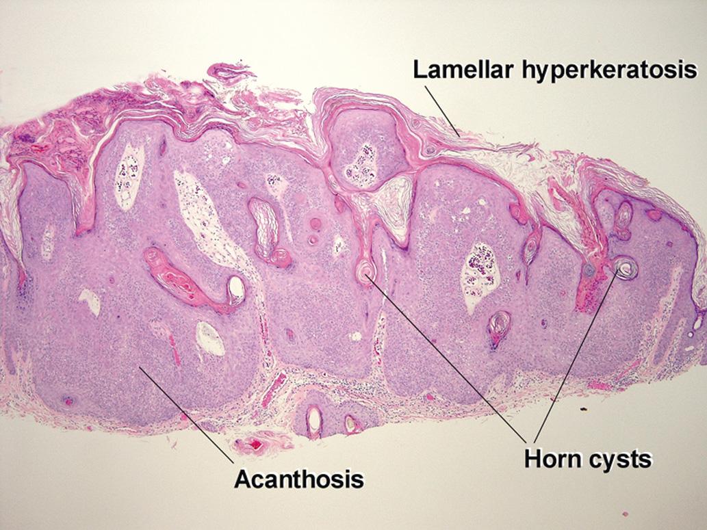 Fig. 2.1, Acanthotic seborrheic keratosis